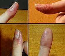 Particularly devious and magnificent villains have a habit of putting their hands together at around … following. Dermatophagia Wikipedia