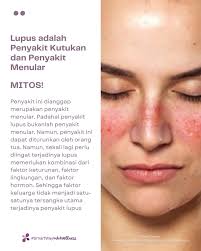 Selain pengunaan obat, pasien lupus harus dijelaskeun mengenai lupus dan  organ yang terlibat pada pasien, pola hidup sehat seperti aktivitas fisik  dan olahraga dan nutrisi, edukasi terkait kesehatan perempuan, hal-hal yang  harus