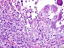 In a child with esophagoscopy showing erythema with or without ulceration and esophageal biopsy revealing inflammation, hsv etiology was established based on the presence of one or more of the following criteria: Pathology Outlines Herpes Simplex Zoster