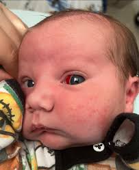 Baby's facial bruising and bloodshot eye after getting stuck during birth