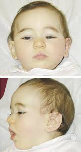 Noonan syndrome is a genetic disorder that prevents normal development in various parts of the body. Front And Side Views Of The Patient At 10 Month Age Revealed Bilateral Download Scientific Diagram