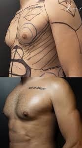 Ex-BBB Caio Afiune mostra corpo após lipo LAD avançada e ginecomastia;  compare