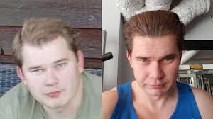 That hair is going to grow back once. Can Derma Rolling Cause Some Temporary Shedding Youtube