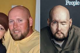 Aaron James Just Received the First Eye and Face Transplant (Exclusive)