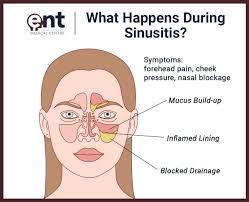Image result for Sinusitis Prediction Rule