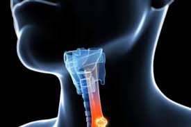 Throat cancer refers to cancer of the voice box, vocal cords, and other parts of the throat, such as the tonsils and the oropharynx. Throat Cancer Symptoms Treatment University Health News