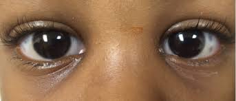 Image result for nevus sclerae