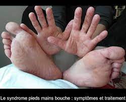 Elle atteint principalement les enfants en bas âge (de 6 mois à 4 ans). Le Syndrome Pieds Mains Bouche Symptomes Et Traitement