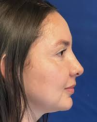 4 años después de su RINOPLASTÍA