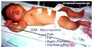 Macrosomia Altered Fetal Growth In Gestational Diabetes