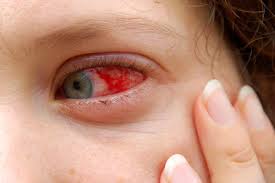 Ojos Rojos Lista De Causas Mas Comunes