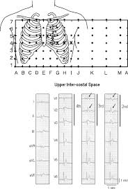 Camel's hump (alternatively camels hump) is a mountain in the green mountains in the u.s. Brugada Syndrome Antzelevitch 2006 Pacing And Clinical Electrophysiology Wiley Online Library