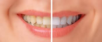 Fluoride Treatment Portland Or Hunter Dental Care