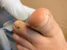 Maybe you would like to learn more about one of these? Black Spot Under The Toenail Causes Home Remedies Best Treatment