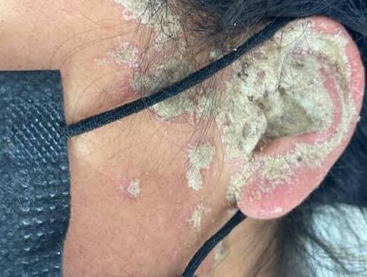 La sarna costrosa, también llamada sarna noruega, tiende a dale a la piel  una apariencia seca y escamosa, y a afectar zonas extensas del cuerpo. Es  muy contagiosa y puede ser difícil