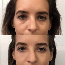 They are running a special right now with fillers for buy 2 get the 3rd 50% off. Under Eye Fillers Dark Circle Reduction Before And After Photos Dallas