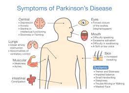 Parkinson's disease is a progressive disorder that is caused by degeneration of nerve cells in the part of the studies have shown that symptoms of parkinson's develop in patients with an 80 percent or. Parkinson S Disease Signs Risks And Treatme Ceufast Com Blog
