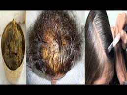 قامت بوضعه علي الرأس وبعد اسبوع انبات الشعر وملأ الفراغات بسرعه رهيبة كالباروكه Hair Treatment Youtube Health
