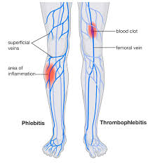 They can cause sudden bleeding, so they are used only. Phlebitis And Blood Clots Preferred Vascular Group