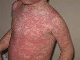 April 2016 Paine Podcast And Medical Blog Allergic Reaction Rash Amoxicillin Rash Medical