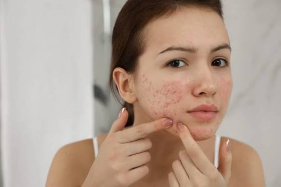 Acne Scars | DermaKācā