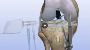 Ligaments connect these bones to each other. Acl Reconstruction Surgery Procedure And Recovery Hss