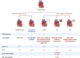 Image result for Left Ventricular Hypertrophy
