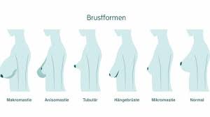 Ab wann gelten brüste eigentlich als hängebrüste? Brustfehlbildungen Arten Von Brustdeformitaten Und Ihre Korrektur