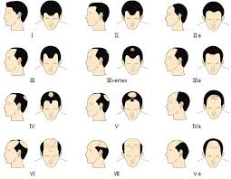 It's really normal to have an uneven hairline on your neck. Why Is My Hairline Receding At 21 And How Do Doctors Diagnose The Root Cause For Hair Loss