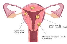 Fachsprachlich heißt die muskelschicht der gebärmutter myometrium und die gebärmutter. Myome Kinderwunsch Schwangerschaft Behandlung Risiken 9monate De