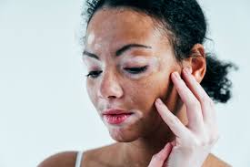 Image result for Vitiligo