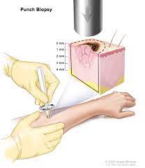 Signs of skin cancers include changes in the appearance of a mole or spot on the skin or the emergence of a new spot or lump on the skin. Skin Cancer Treatment Pdq Patient Version National Cancer Institute