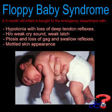 Image result for Floppy Infant