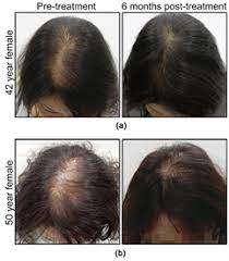 Research has shown that hair loss can be reduced with lysine supplementation 6 ideal food sources for lysine include fish (especially salmon, sardines and cod), dairy products, poultry, red meat, pork, legumes, nuts, spirulina and pulses. Combination Therapy To Treat Asian Female Pattern Hair Loss