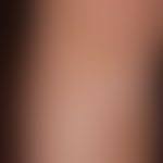 À tout moment, où que vous soyez, sur tous vos appareils. Pityriasis Alba Altmeyers Enzyklopadie Fachbereich Dermatologie