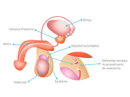 The vas deferens is the duct that. Vasectomia Onde E Quando Fazer Urologista Em Joinville Sc