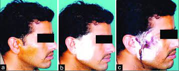 Application Of 1 Iodine Over The Affected Area A Application Of Download Scientific Diagram