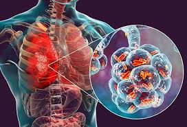 Bacterial Pneumonia Contagious Period, Treatment & Symptoms
