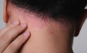 Image result for dry scabs on the head in children