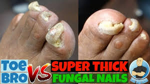 t of super thick fungal nails