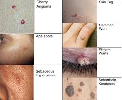 There are several options for doing this. New Treatment Harmony Laser And Aesthetics Clinic Facebook