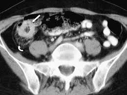 Image result for Neutropenic Colitis