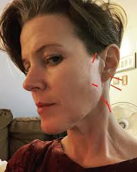 Acupuncture by Ludmilla