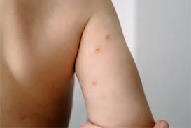 Image result for Berdazimer