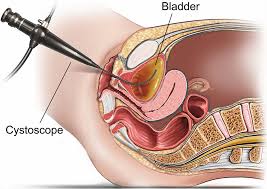 After all, it's far more common among men than women, and the majority of cases affect patients over age 65. Flexible Cystoscopy Female Healthdirect
