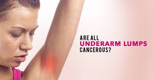 Skin changes in the breast such as puckering, dimpling. Worried About An Underarm Lumps Find Out What It Means