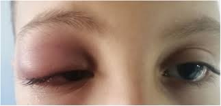 Image result for Dacryoadenitis