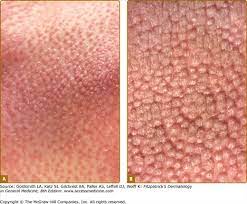 It can occur at any age but is more common in persons between the ages of 10 to 50 years. Pityriasis Rubra Pilaris Plastic Surgery Key