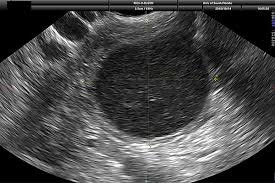 The us images are of a young pregnant woman, who had multiple ovarian cysts. Watchful Waiting With Routine Ultrasound Safer Than Removing Benign Ovarian Cysts Study Suggests Usf Health Newsusf Health News