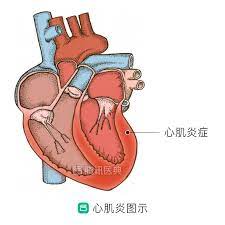 May 29, 2021 · 青少年要不要打疫苗？青少年打疫苗的副作用是什么？一种情况不能打！三个症状提示疫苗心肌炎！ 杨医生的一个15岁病人接种疫苗之后，出现了严重的副作用甚至抑郁症，这是怎么回事？ å¿ƒè‚Œç‚Žæ²»ç–— ç¾Žå›½æ—¥æœ¬æ²»ç–—å¿ƒè‚Œç‚Ž å‡ºå¢ƒåŒ»